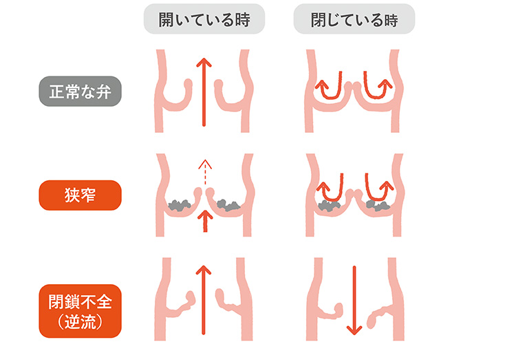 心臓弁膜症ってどんな病気？
