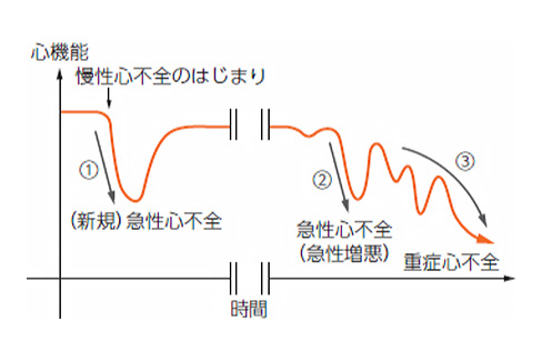 心不全とは